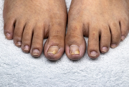 Unghie dei piedi gialle: onicomicosi