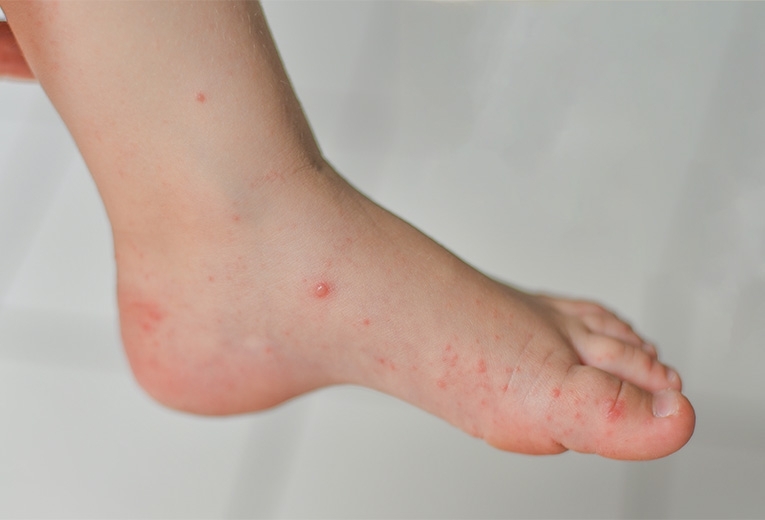 Malattia Bocca Mani Piedi nei bambini, come riconoscerla Malattia Bocca Mani Piedi nei bambini, come riconoscerla