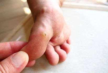 Calli ai piedi: come prevenirli Calli ai piedi: come prevenirli