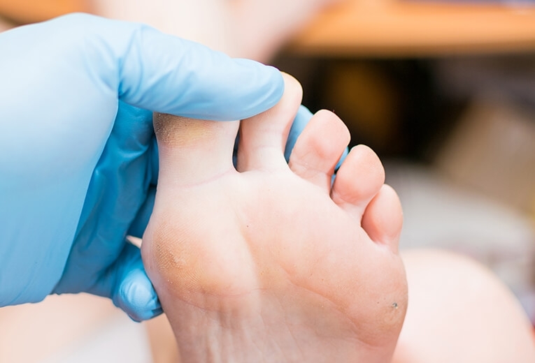 Calli ai piedi: plantari su misura Calli ai piedi: plantari su misura