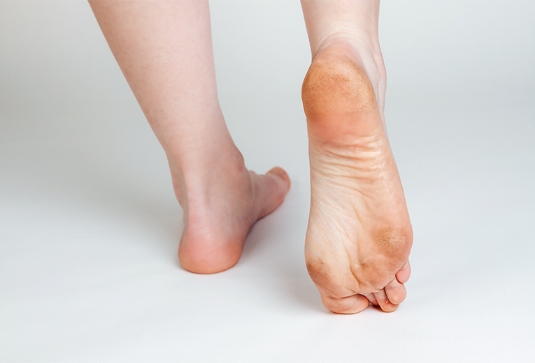 Calli ai piedi: come prevenirli? Calli ai piedi: come prevenirli?
