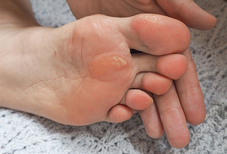Calli ai piedi: cause, prevenzione e rimedi Calli ai piedi: cause, prevenzione e rimedi