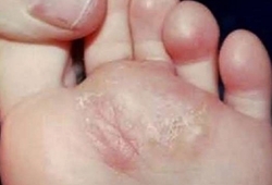 Disidrosi: i piedi  Disidrosi: i piedi