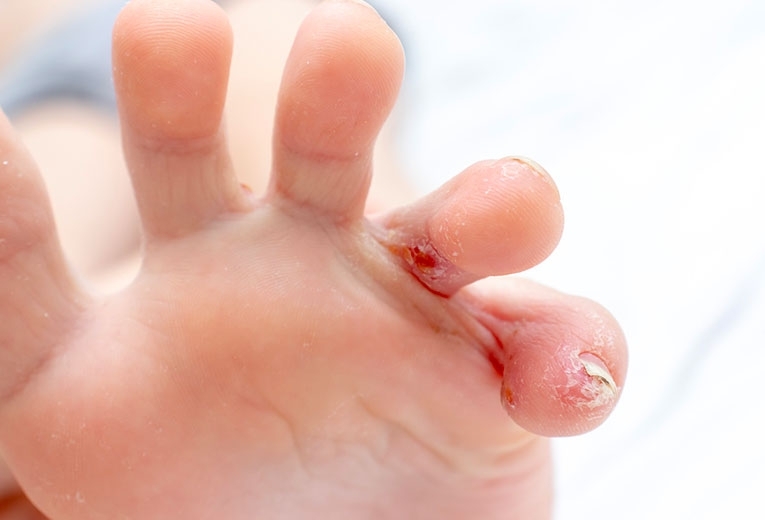 Piedi squamati: la Disidrosi  Piedi squamati: la Disidrosi