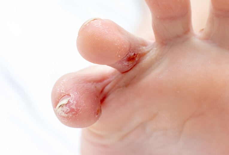 Come curare la Disidrosi ai piedi Come curare la Disidrosi ai piedi