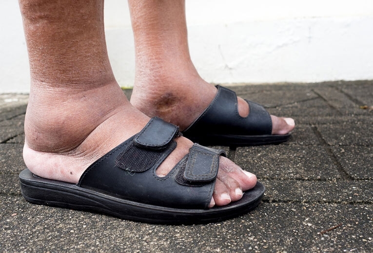 Il piede diabetico: cosa fare? Il piede diabetico: cosa fare?