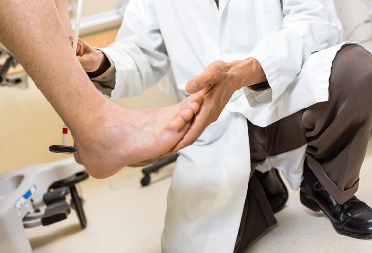 Il cedimento dell'arco plantare Il cedimento dell'arco plantare