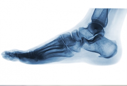 La Spina calcaneare La Spina calcaneare