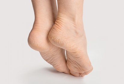Disidrosi ai piedi: cos'è e come trattarla? Disidrosi ai piedi: cos'è e come trattarla?