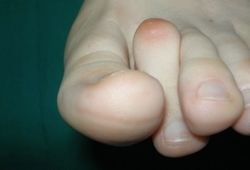 Dito in griffe o ad artiglio. Di cosa parliamo? Dito in griffe o ad artiglio. Di cosa parliamo?