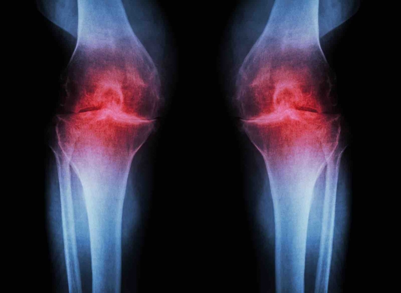 Ginocchio valgo e plantari Ginocchio valgo e plantari