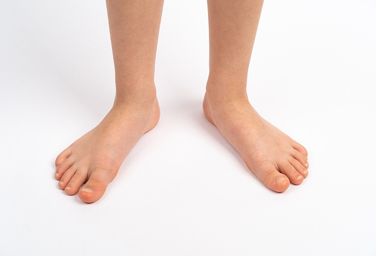 Piedi piatti: cause e trattamenti Piedi piatti: cause e trattamenti