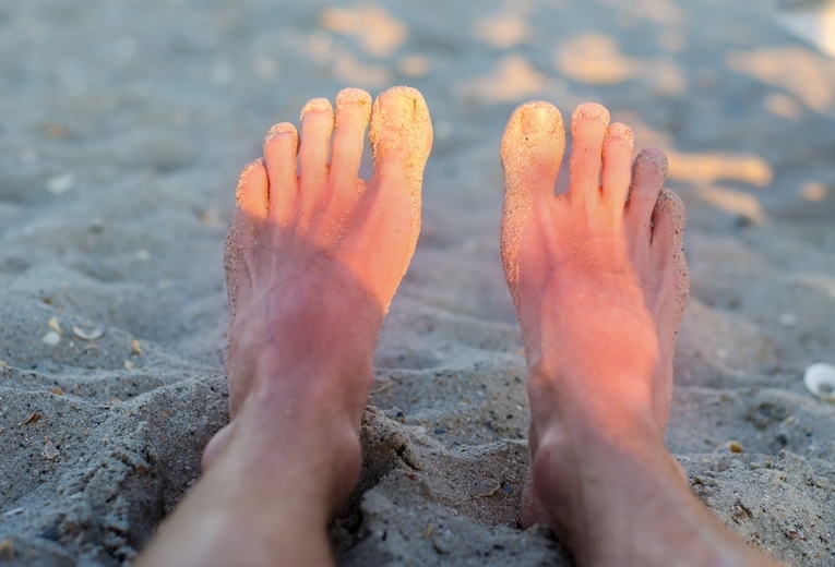 Piedi bruciati dal sole Piedi bruciati dal sole