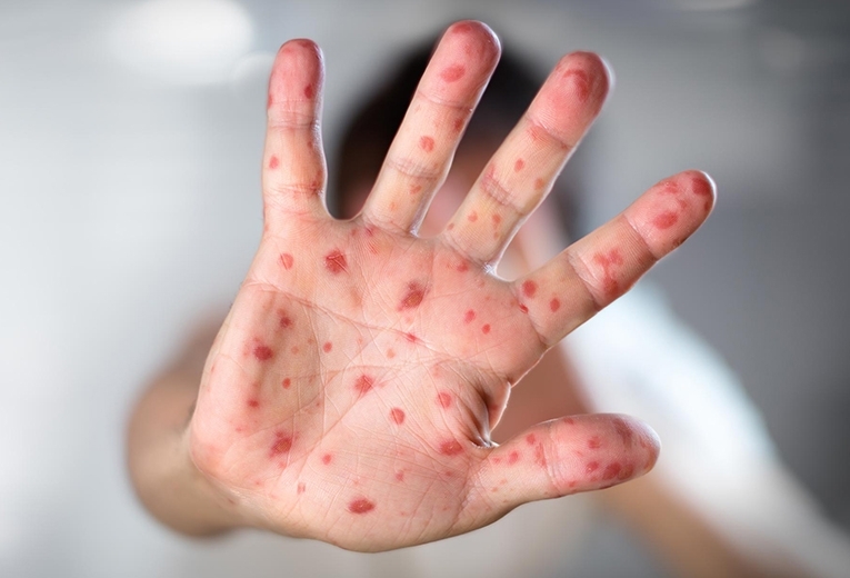 Virus Mani Bocca Piedi nei bambini Virus Mani Bocca Piedi nei bambini