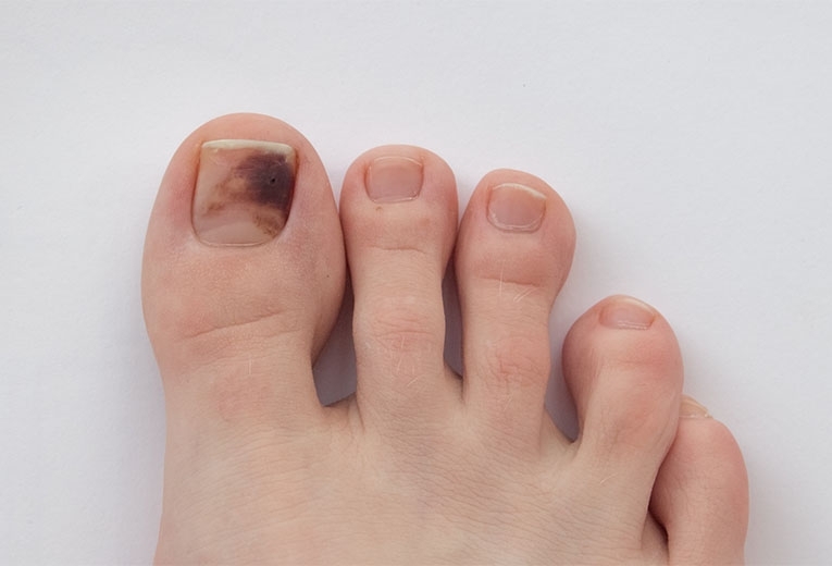 Unghie nere piedi: cosa fare? Unghie nere piedi: cosa fare?