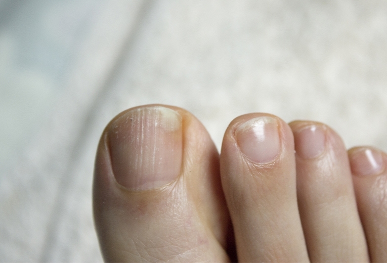 Unghie rigate: cosa significano? Unghie rigate: cosa significano?