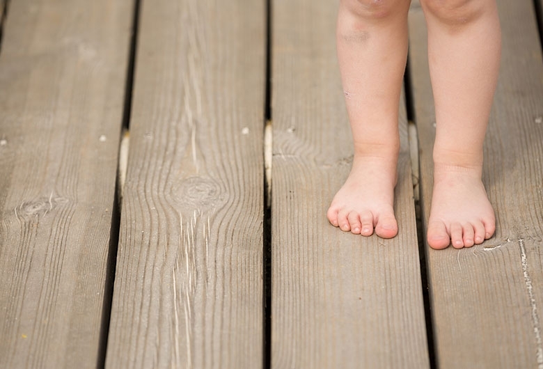 I piedi piatti nei bambini  I piedi piatti nei bambini