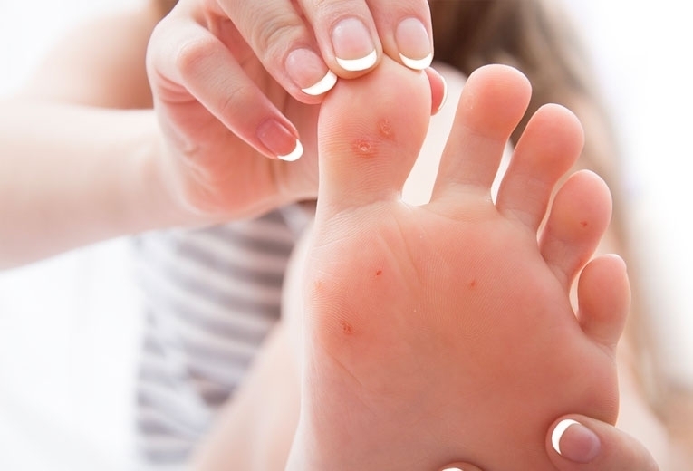 Verruche ai piedi: di cosa si tratta? Verruche ai piedi: di cosa si tratta?